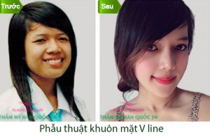Kết hợp các phương pháp phẫu thuật gọt mặt V line, cấy mỡ thái dương, phẫu thuật hàm hô, nâng mũi S line và thẩm mỹ mắt tại Thẩm mỹ Hàn Quốc JW đã giúp Minh Yến cải thiện toàn bộ khuôn mặt thô bạnh, đầy khiếm khuyết trước đó
