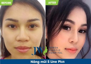Trước và sau khi phẫu thuật với công nghệ S Line Plus