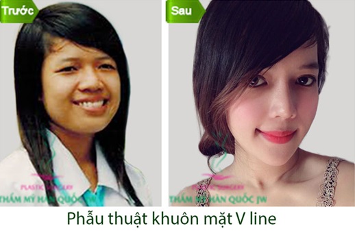 Kết hợp các phương pháp phẫu thuật gọt mặt V line, cấy mỡ thái dương, phẫu thuật hàm hô, nâng mũi S line và thẩm mỹ mắt tại Thẩm mỹ Hàn Quốc JW đã giúp Minh Yến cải thiện toàn bộ khuôn mặt thô bạnh, đầy khiếm khuyết trước đó
